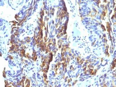Immunohistochemistry-Paraffin: Melanoma Associated Antigen (KBA.62) Antibody (KBA.62) - Azide and BSA Free [NBP3-11535] - Human Tongue stained with Melanoma Monoclonal Antibody (KBA.62).