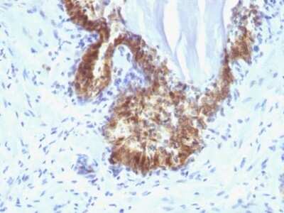Immunohistochemistry-Paraffin: Kallikrein 3/PSA Antibody (KLK3/1248) - Azide and BSA Free [NBP3-11549] - Human Prostate Carcinoma stained with PSA Monoclonal Antibody (KLK3/1248).