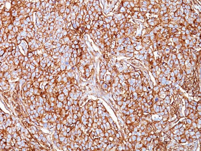 Formalin-fixed, paraffin-embedded human Breast Carcinoma stained with CD44 Antibody (SPM521) - Azide and BSA Free