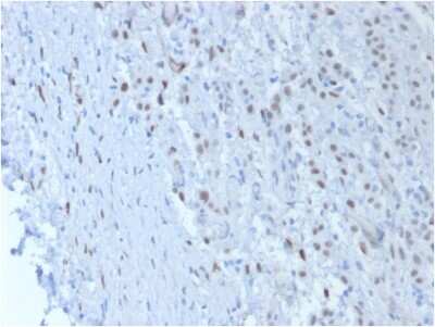 Immunohistochemistry-Paraffin: WT1 Antibody (SPM361) - Azide and BSA Free [NBP3-11553] - Formalin-fixed, paraffin-embedded human Mesothelioma stained with WT1 Antibody (SPM361).