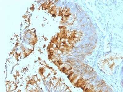 Immunohistochemistry-Paraffin: Lewis A Blood Group Antigen Antibody (SPM279) - Azide and BSA Free [NBP3-11560] - Human Colon Carcinoma stained with Lewis A Monoclonal Antibody (SPM279).