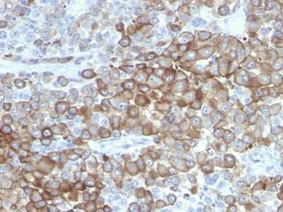 Immunohistochemistry-Paraffin: Melanoma Associated Antigen (PNL2) Antibody (PNL2) - Azide and BSA Free [NBP3-11561] - Human Melanoma stained with PNL2 Monoclonal Antibody.