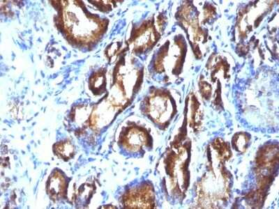 Immunohistochemistry-Paraffin: Kallikrein 3/PSA Antibody (KLK3/801 + KLK3/1248) - Azide and BSA Free [NBP3-11567] - Human Prostate Carcinoma stained with PSA Monoclonal Antibody (KLK3/801 + KLK3/1248).