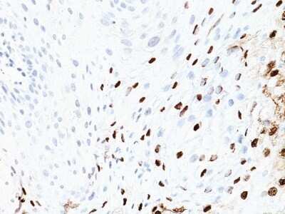 Immunohistochemistry-Paraffin: HPV16 Antibody (SPM405) - Azide and BSA Free [NBP3-11575] - Human Cervix stained with HPV-16 Monoclonal Antibody (SPM405)