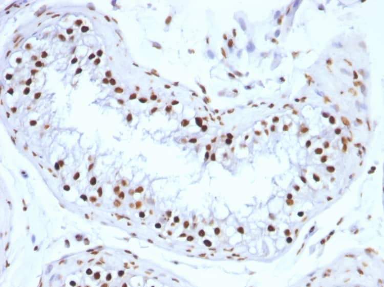 Formalin-fixed, paraffin-embedded human Testicular Carcinoma stained with H1F0 Antibody (SPM256) - Azide and BSA Free