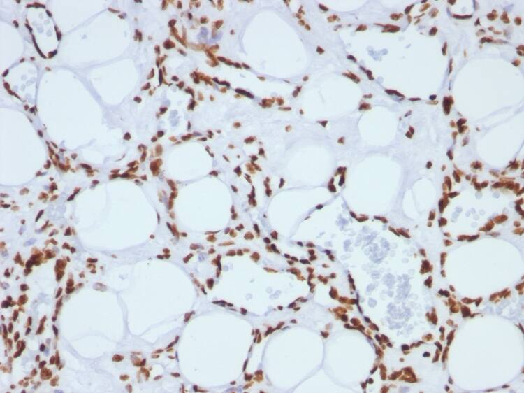 Formalin-fixed, paraffin-embedded human Angiosarcoma stained with H1F0 Antibody (SPM256) - Azide and BSA Free.