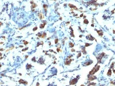 Immunohistochemistry-Paraffin: MUC3 Antibody (SPM200) - Azide and BSA Free [NBP3-11579] - Human Gastric Carcinoma stained with MUC3 Monoclonal Antibody (SPM200).
