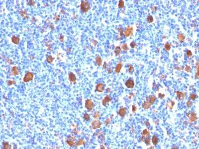 Immunohistochemistry-Paraffin: Fascin Antibody (FSCN1/416) - Azide and BSA Free [NBP3-11582] - Human Hodgkin's Lymphoma stained with Fascin-1 Monoclonal Antibody (FSCN1/416)