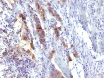 Immunohistochemistry-Paraffin: MUC5AC Antibody (SPM488) - Azide and BSA Free [NBP3-11583] - Human Gastric Carcinoma stained with MUC5AC Monoclonal Antibody (SPM488).