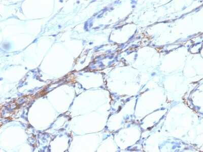 Immunohistochemistry-Paraffin: Myosin heavy chain 11 Antibody (SPM201) - Azide and BSA Free [NBP3-11585] - Human Angiosarcoma stained with SM-MHC Monoclonal Antibody (SPM201).