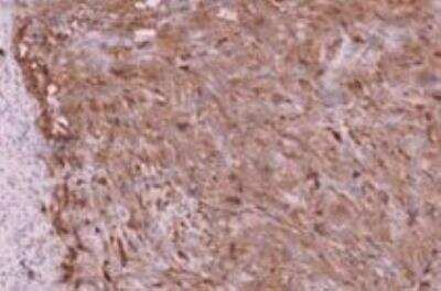 Immunohistochemistry-Paraffin: CA19-9/Sialyl Lewis A Antibody (SPM588) - Azide and BSA Free [NBP3-11589] - Human thyroid carcinoma tissue section. Fixed with 4% formaldehyde, incubated O/N at 4C with primary antibody. IHC-P image submitted by a verified customer review.
