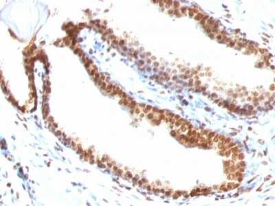 Immunohistochemistry-Paraffin: DNA Antibody (DSD/958) - Azide and BSA Free [NBP3-11590] - Human Colon Carcinoma stained with Double Stranded DNA Monoclonal Antibody (DSD/958)