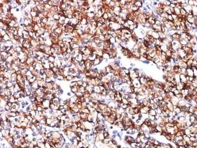 Immunohistochemistry-Paraffin: Carbonic Anhydrase IX/CA9 Antibody (CA9/781) - Azide and BSA Free [NBP3-11591] - Human Renal Cell Carcinoma stained with CAIX Monoclonal Antibody (CA9/781).