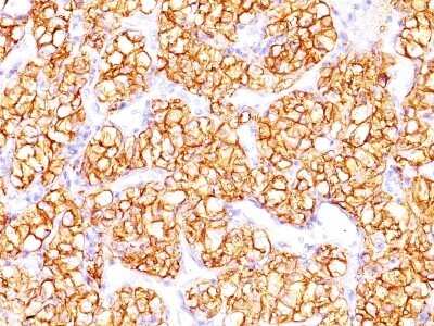 Immunohistochemistry-Paraffin: Carbonic Anhydrase IX/CA9 Antibody (PN-15) - Azide and BSA Free [NBP3-11592] - Human Renal Cell Carcinoma stained with PNA Monoclonal Antibody (PN-15).