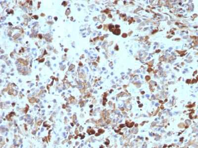 Immunohistochemistry-Paraffin: MITF Antibody (MITF/915) - Azide and BSA Free [NBP3-11593] - Formalin-fixed, paraffin-embedded human Melanoma stained with MITF Antibody (MITF/915).