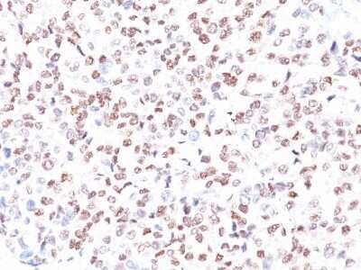 Immunohistochemistry-Paraffin: MITF Antibody (MITF/915) - Azide and BSA Free [NBP3-11593] - Human Melanoma stained with MITF Monoclonal Antibody (MITF/915).