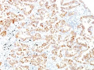 Immunohistochemistry-Paraffin: Cytokeratin 7 Antibody (SPM270) - Azide and BSA Free [NBP3-11594] - Human Lung SCC stained with Cytokeratin 7 Monoclonal Antibody (SPM270)