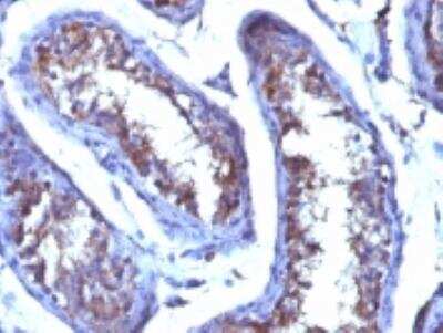 Immunohistochemistry-Paraffin: Testosterone Antibody (4E1G2) - Azide and BSA Free [NBP3-11603] - Formalin-fixed, paraffin-embedded human testicular carcinoma stained with Testosterone monoclonal antibody (4E1G2).