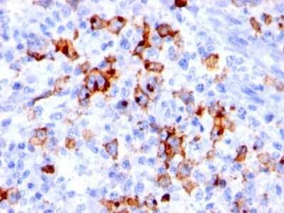 Immunohistochemistry-Paraffin: SSEA-1 Antibody (BRA-4F1) - Azide and BSA Free [NBP3-11604] - Human Hodgkin's lymphoma stained with CD15 Monoclonal Antibody (BRA-4F1).