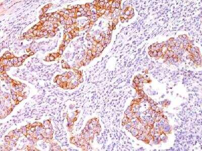 Immunohistochemistry-Paraffin: Phospho-Tyrosine Antibody (SPM102) - Azide and BSA Free [NBP3-11616] - Formalin-fixed paraffin-embedded human breast carcinoma stained with phosphotyrosine monoclonal antibody (SPM102)