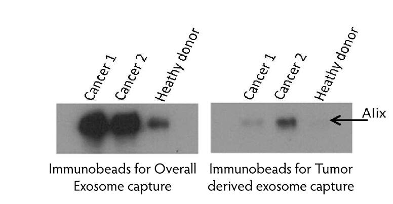 CD9 Immunobeads for Exosome Isolation [NBP3-11768] - Anti-Alix WB analysis on exosomes immunocaptured with beads for overall (NBP3-11768) and for tumor-derived exosomes (NBP3-14798). WB shows the capture of exosomes only for cancer patients when beads for tumor-derived exosomes are used.