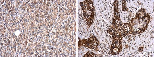 Glypican 1 antibody detects Glypican 1 protein at cell membrane in human pancreas by immunohistochemical analysis. Sample: Paraffin-embedded human pancreas, normal (left) and cancer (right). Glypican 1 antibody (NBP3-13127) diluted at 1:250. br>Antigen Retrieval: Citrate buffer, pH 6.0, 15 min 
