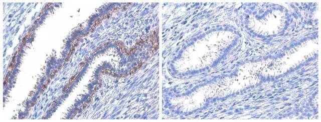 <b>Biological Strategies Validation. </b>Her2 / ErbB2 (phospho Tyr1221/Tyr1222) antibody detects Her2 / ErbB2 (phospho Tyr1221/Tyr1222) protein at cell membrane by immunohistochemical analysis in the presence of control peptide (left) or antigen-specific peptide (right).Sample: Paraffin-embedded human breast carcinoma.Her2 / ErbB2 (phospho Tyr1221/Tyr1222) stained by Her2 / ErbB2 (phospho Tyr1221/Tyr1222) antibody (NBP3-13232) diluted at 1:1000. Antigen Retrieval: Citrate buffer, pH 6.0, 15 min 