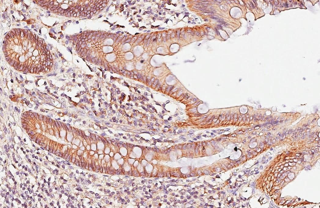 beta Catenin antibody [GT2169] detects beta Catenin protein by immunohistochemical analysis.Sample: Paraffin-embedded human appendix.beta Catenin stained by beta Catenin antibody [GT2169] (NBP3-13530) diluted at 1:500.Antigen Retrieval: Citrate buffer, pH 6.0, 15 min 