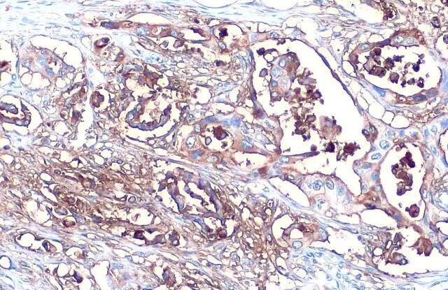 Immunohistochemistry-Paraffin: CA19-9/Sialyl Lewis A Antibody (GT252) [NBP3-13651] - CA19-9/Sialyl Lewis A antibody [GT252] detects CA19-9/Sialyl Lewis A protein at cytoplasm by immunohistochemical analysis.Sample: Paraffin-embedded human pancreatic cancer.CA19-9/Sialyl Lewis A stained by CA19-9/Sialyl Lewis A antibody [GT252] (NBP3-13651) diluted at 1:500.Antigen Retrieval: Citrate buffer, pH 6.0, 15 min