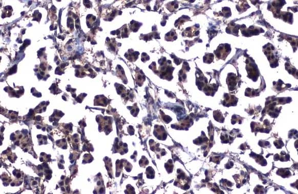 Immunohistochemistry-Paraffin: ATM Antibody (2C1-RB) [NBP3-13655] - ATM antibody [2C1-RB] detects ATM protein at nucleus by immunohistochemical analysis.Sample: Paraffin-embedded human breast carcinoma.ATM stained by ATM antibody [2C1-RB] (NBP3-13655) diluted at 1:200.Antigen Retrieval: Citrate buffer, pH 6.0, 15 min