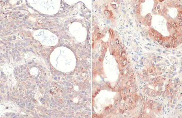 RAS (G12V Mutant) antibody [HL169] detects RAS (G12V Mutant) protein at cell membrane and cytoplasm by immunohistochemical analysis.Sample: Paraffin-embedded BxPC-3 xenograft (left) and CFPAC-1 xenograft (right).RAS (G12V Mutant) stained by RAS (G12V Mutant) antibody [HL169] (NBP3-13668) diluted at 1:50.Antigen Retrieval: Citrate buffer, pH 6.0, 15 min 