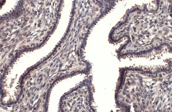 Immunohistochemistry-Paraffin: RPB2 Antibody (HL1042) [NBP3-13697] - RPB2 antibody [HL1042] detects RPB2 protein at nucleus by immunohistochemical analysis.Sample: Paraffin-embedded human breast carcinoma.RPB2 stained by RPB2 antibody [HL1042] (NBP3-13697) diluted at 1:100.Antigen Retrieval: Citrate buffer, pH 6.0, 15 min