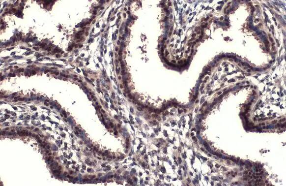 Immunohistochemistry-Paraffin: RPB2 Antibody (HL1043) [NBP3-13698] - RPB2 antibody [HL1043] detects RPB2 protein at nucleus by immunohistochemical analysis.Sample: Paraffin-embedded human breast carcinoma.RPB2 stained by RPB2 antibody [HL1043] (NBP3-13698) diluted at 1:100.Antigen Retrieval: Citrate buffer, pH 6.0, 15 min