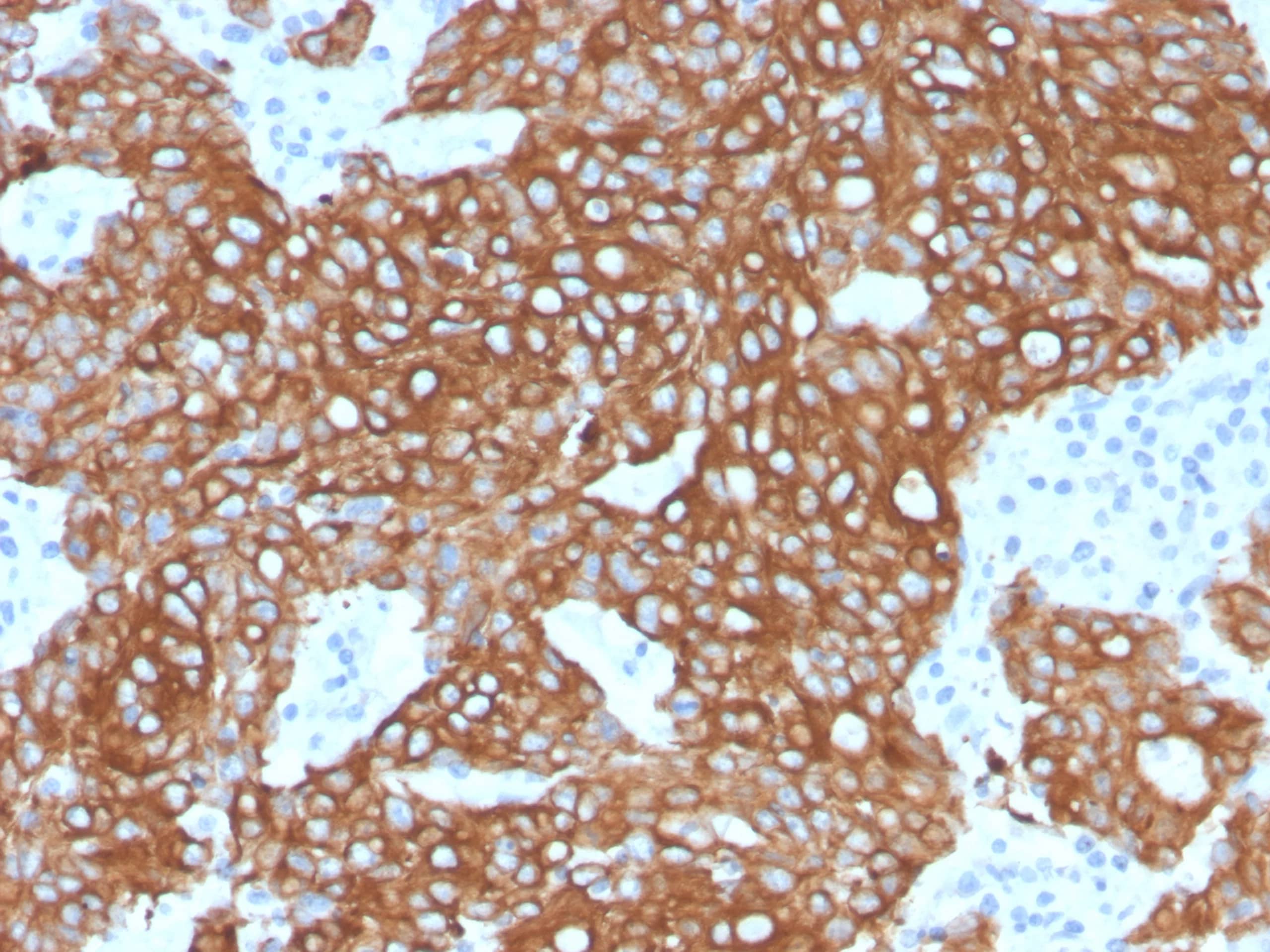 Cytokeratin 8/18 Antibody (KRT8.18/6579R) KRT8/18 Recombinant Rabbit Monoclonal Antibody (KRT8.18/6579R). HIER: Tris/EDTA, pH9.0, 45min. 2°: HRP-polymer, 30min. DAB, 5min.