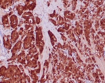 FFPE prostate carcinoma with IDH1-R132H mutation stained with Isocitrate Dehydrogenase 1/IDH1 antibody (IDH1/6806R).