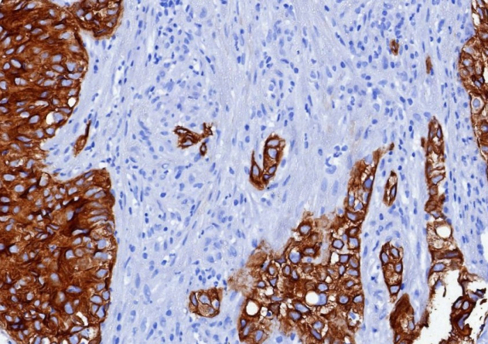 Formalin-fixed, paraffin-embedded human bladder carcinoma pT24 stained with Cytokeratin 6a antibody (KRT6/3997R). HIER: Tris/EDTA, pH9.0, 45min. Secondary: HRP-polymer, 30min. DAB, 5min.