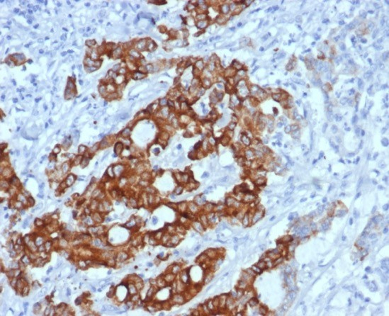 Formalin-fixed, paraffin-embedded human colon carcinoma stained with MUC6 antibody (MUC6/7069R). HIER: Tris/EDTA, pH9.0, 45min. Secondary: HRP-polymer, 30min. DAB, 5min.