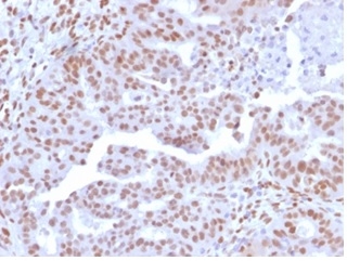 Formalin-fixed, paraffin-embedded human colon carcinoma stained with NFIA antibody (PCRP-NFIA-2C6). HIER: Tris/EDTA, pH9.0, 45min. Secondary: HRP-polymer, 30min. DAB, 5min.