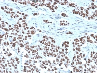 Formalin-fixed, paraffin-embedded human lung stained with NFIA antibody (PCRP-NFIA-2C6). HIER: Tris/EDTA, pH9.0, 45min. Secondary: HRP-polymer, 30min. DAB, 5min.