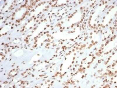 Immunohistochemistry-Paraffin: Ku80/XRCC5 Antibody (XRCC5/7315) - Azide and BSA Free [NBP3-14017] - Formalin-fixed, paraffin-embedded human colon carcinoma stained with Ku80/XRCC5 antibody (XRCC5/7315). HIER: Tris/EDTA, pH9.0, 45min. HRP-polymer, 30min. DAB, 5min.