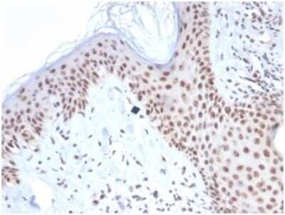 Immunohistochemistry-Paraffin: NPM1 Antibody (NPM1/7072R) - Azide and BSA Free [NBP3-14019] - Formalin-fixed, paraffin-embedded human basal cell carcinoma stained with NPM1 antibody (NPM1/7072R). HIER: Tris/EDTA, pH9.0, 45min. HRP-polymer, 30min. DAB, 5min.