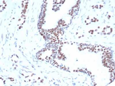 Immunohistochemistry-Paraffin: FoxP1 Antibody (rFOXP1/6902) - Azide and BSA Free [NBP3-14022] - Formalin-fixed, paraffin-embedded human prostate carcinoma stained with FoxP1 antibody (rFOXP1/6902) [1ug/ml in PBS] for 30min RT. HIER: Tris/EDTA, pH9.0, 45min. HRP-polymer, 30min. DAB, 5min