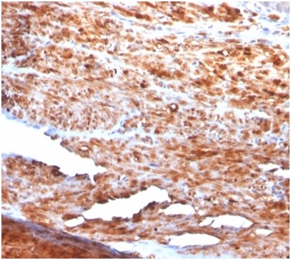 IHC analysis of formalin-fixed, paraffin-embedded human uterus. Stained using Desmin antibody (rDES/1711) at 2ug/ml in PBS for 30min RT. HIER: Tris/EDTA, pH9.0, 45min. Secondary: HRP-polymer, 30min. DAB, 5min.