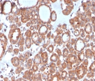 Formalin-fixed, paraffin-embedded human thyroid stained with Calcitonin antibody (CALCA/3310). HIER: Tris/EDTA, pH9.0, 45min. Secondary: HRP-polymer, 30min. DAB, 5min.