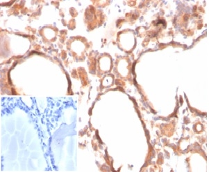 Formalin-fixed, paraffin-embedded human thyroid stained with Calcitonin antibody (CALCA/3310). Inset: PBS instead of primary antibody; secondary only negative control.