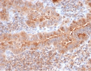 Formalin-fixed, paraffin-embedded human thyroid stained with Calcitonin antibody (CALCA/3310). HIER: Tris/EDTA, pH9.0, 45min. Secondary: HRP-polymer, 30min. DAB, 5min.