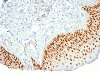 Formalin-fixed, paraffin-embedded human prostate cancer stained with p40/deltaNp63 antibody (P40/7302R). HIER: Tris/EDTA, pH9.0, 45min. Secondary: HRP-polymer, 30min. DAB, 5min.