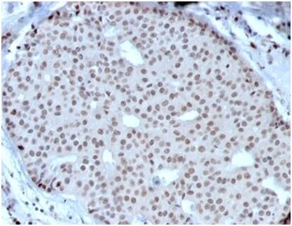 IHC analysis of formalin-fixed, paraffin-embedded human breast carcinoma. Nuclear staining using HOXB2 Antibody (PCRP-HOXB2-1F2) - Azide and BSA Free at 2ug/ml in PBS for 30min RT. HIER: Tris/EDTA, pH9.0, 45min. 2 °: HRP-polymer, 30min. DAB, 5min.