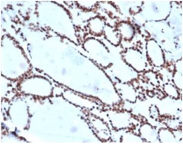 IHC analysis of formalin-fixed, paraffin-embedded human thyroid. Nuclear staining using HOXB2 Antibody (PCRP-HOXB2-1F2) - Azide and BSA Free at 2ug/ml in PBS for 30min RT. HIER: Tris/EDTA, pH9.0, 45min. 2 °: HRP-polymer, 30min. DAB, 5min.