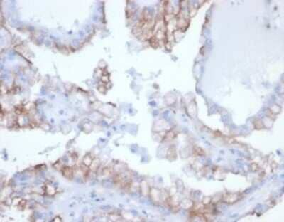 Immunohistochemistry-Paraffin: Cdc20 Antibody (rCDC20/7184) - Azide and BSA Free [NBP3-14074] - Formalin-fixed, paraffin-embedded human kidney cancer stained with Cdc20 antibody (rCDC20/7184) at 2ug/ml. HIER: Tris/EDTA, pH9.0, 45min. HRP-polymer, 30min. DAB, 5min.